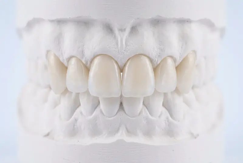Carillas de porcelana finas y translúcidas sobre un modelo dental de yeso
