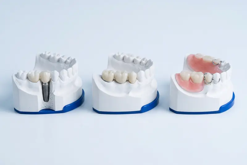 Tres modelos dentales comparados: implante con corona, puente fijo y prótesis removible parcial