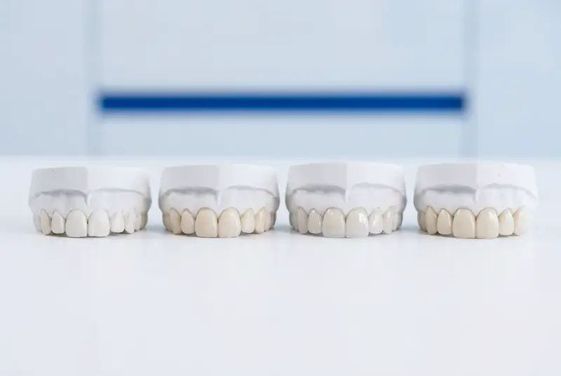 Cuatro modelos dentales en fila que representan niveles crecientes de intervención estética